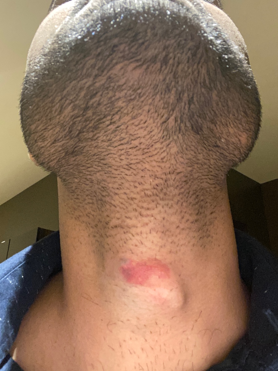 lump inside neck that moves